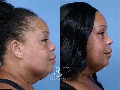 Ultherapy is offered at L&P Aesthetics by select providers, but can get amazing results for the ...