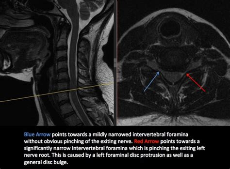 The Pinched Nerve in Your Neck Most Likely Isn't Actually a Pinched Nerve