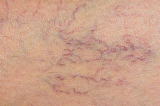 Varicose Veins & Spider Veins: Causes & Treatment | Live Science