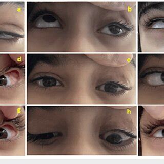 Postoperative clinical photographs of the patient showing improved ...