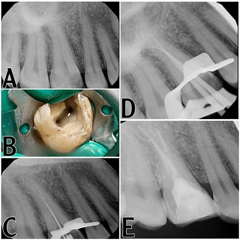 Non-surgical Root Canal Treatment of an Upper First Molar With an Unusual Morphology: A Case ...