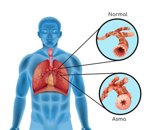 El asma y las dificultades respiratorias - Farma10 Tu Espacio de Salud