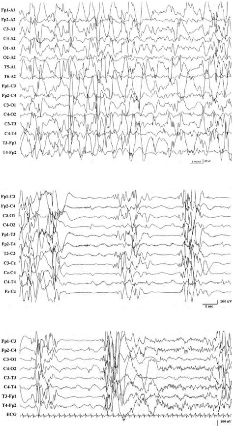 Figure 17 from The EEG in selected generalized seizures. | Semantic Scholar