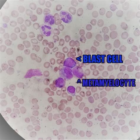 the cell is labeled in blue and purple, with words above it that read blast cell metamyloyote