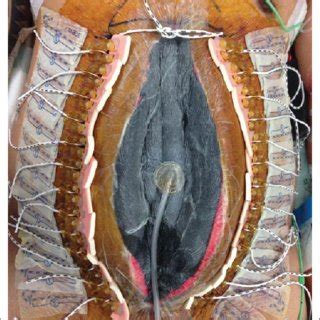 Open abdomen from the patient who had an emergency trauma laparotomy. | Download Scientific Diagram