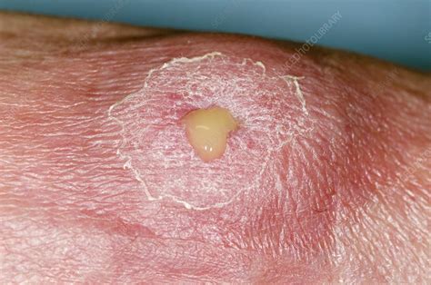 Abscess on the foot - Stock Image - C013/0843 - Science Photo Library