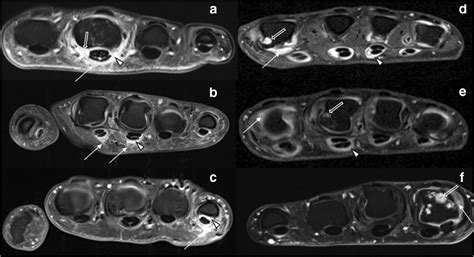 Overview of representative MRI findings in psoriatic arthritis (PsA ...