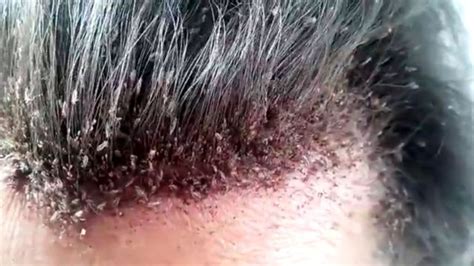 Head lice infestation - Symptoms, causes and risk factors