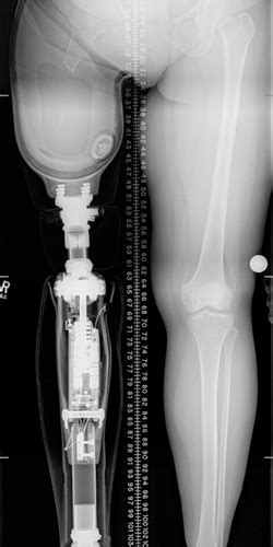 What is Osseointegration | Osseointegration Limb Replacement | CU Denver