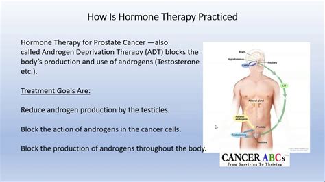 Hormone Therapy SIDE EFFECTS (in prostate cancer) - w/ Joel Nowak, MA, MSW and Jan Manarite ...