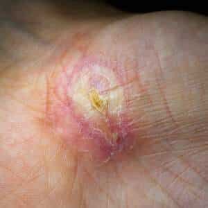 Cellulitis: Everything You Need To Know About This Skin Infection