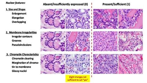 Reclassifying thyroid cancer and the willful misunderstanding of overdiagnosis | Science-Based ...