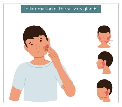 Salivary Glands Disorders: Everything your Need to Know Dentist Ahmed