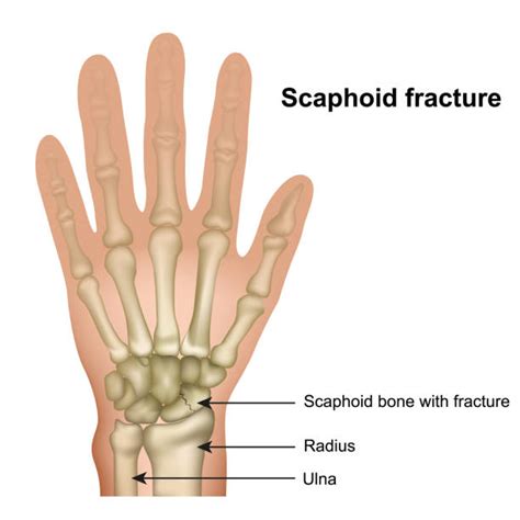 Navicular Bone Of Hand Illustrations, Royalty-Free Vector Graphics ...