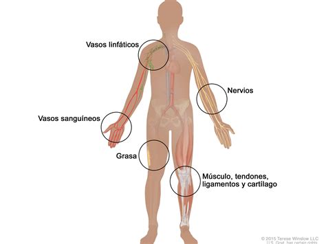 Sarcoma de tejido blando—Versión para pacientes