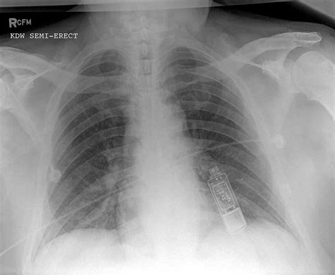 Implantable Loop Recorder Article