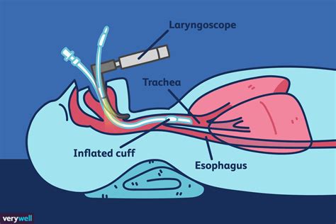 Was ist eine Intubation und warum wird sie durchgeführt?