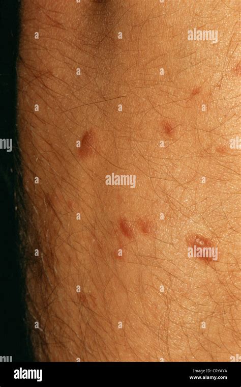 LEIOMYOMA Stock Photo - Alamy