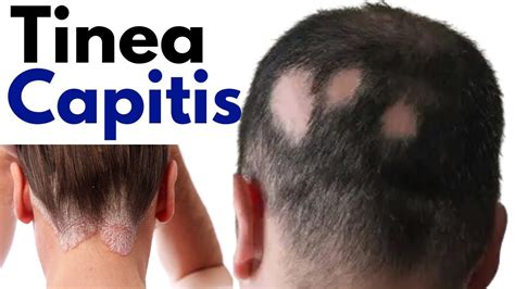 Tinea Capitis Symptoms Treatment Ringworm Of Scalp Tinea