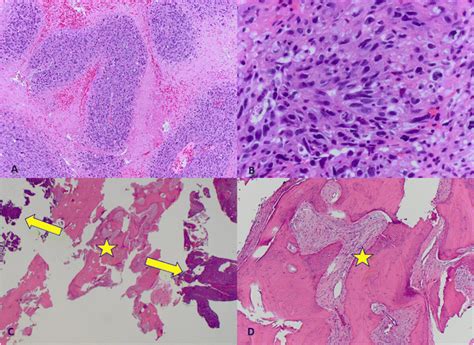 Mpnst Histology