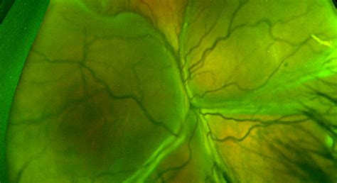 Retinal Detachment: Symptoms, Cause & Diagnosis - Kam Balaggan