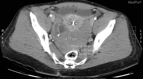 Ovarian Cyst Rupture