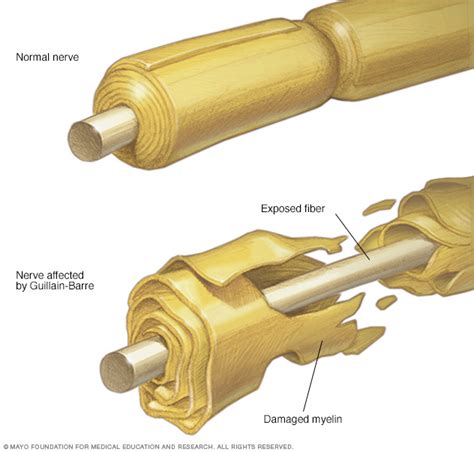 Guillain-Barre syndrome Disease Reference Guide - Drugs.com