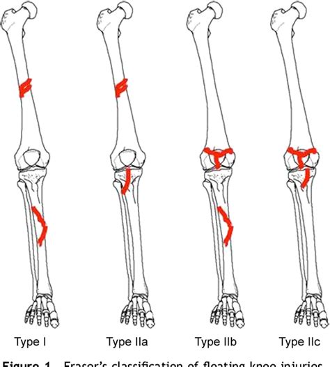 Figure 1 from MINI-SYMPOSIUM : MANAGEMENT OF FRACTURES AROUND THE KNEE JOINT ( ii ) The ...