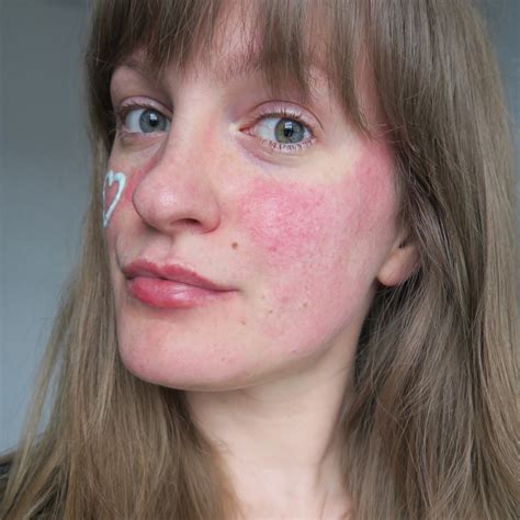 My Rosacea Story With Eau Thermale Avène - AD