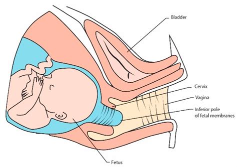 Internal Cervical Os Model Canal