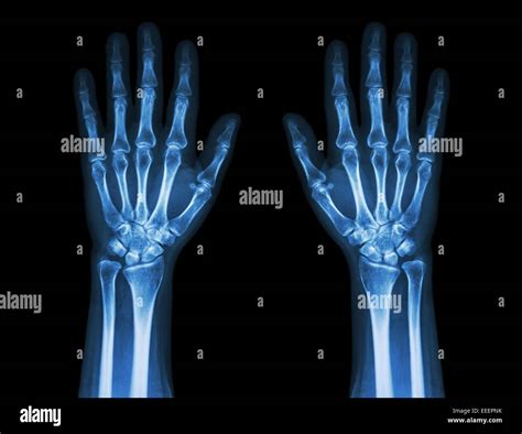 X-Ray Hands ( front view ) : Normal human hands Stock Photo - Alamy