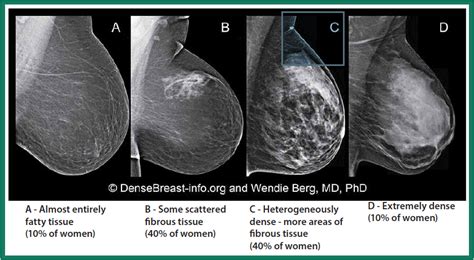 [10000印刷√] heterogeneously dense breast tissue cancer risk 318212 ...