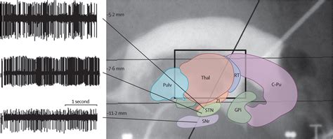 Deep brain stimulation of the subthalamic nucleus for the treatment of Parkinson's disease - The ...