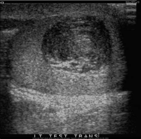 Testicular Cyst Ultrasound