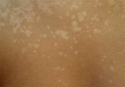 How to Get Rid of Tinea Versicolor (Pityriasis Versicolor) Skin Condition | Healthfully