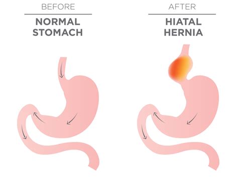 Hiatal Hernia & Acid Reflux Symptoms | The Surgical Clinic