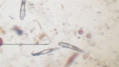 Demodectic Mange Mites, Demodex (Demodex Canis) Seen Under Microscope ...