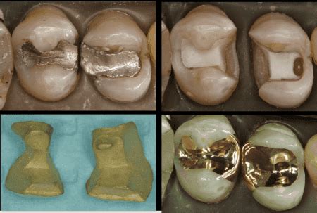 Cast Gold Inlay/Onlay Bur Set – 13 burs | Stevenson Dental Solutions