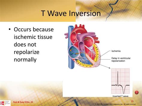 PPT - Myocardial Ischemia, Injury, and Infarction PowerPoint Presentation - ID:3701654