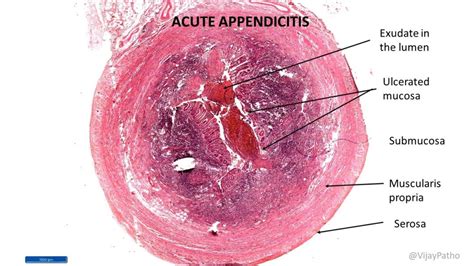 ACUTE APPENDICITIS - Pathology Made Simple