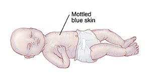 Skin Color Changes in the Newborn | Saint Luke's Health System