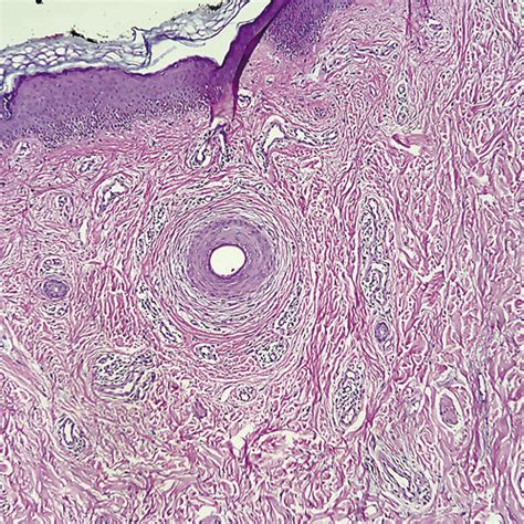 Perifollicular fibrosis and deep dermal fibrosis in the follicular ...