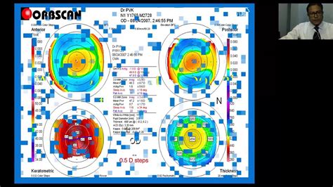 Interpretation of Corneal Topography - YouTube