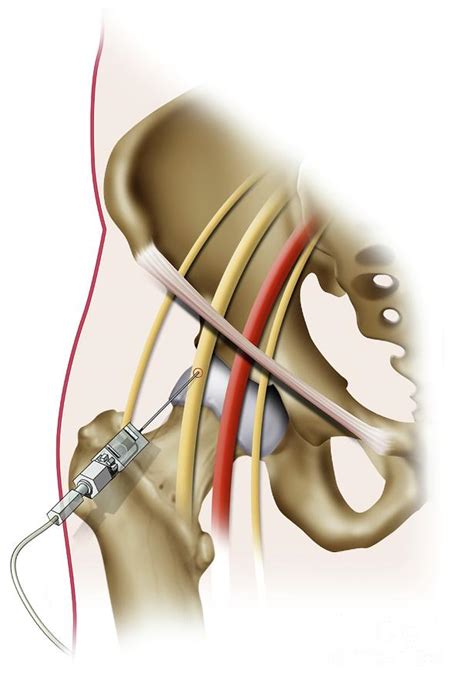 Femoral Nerve Block Injection Photograph by Maurizio De Angelis/science ...