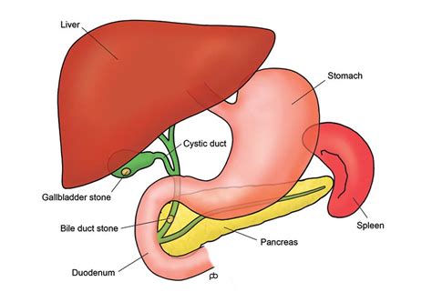 Abeezar Sarela | Gallstones | Laparoscopic Cholecystectomy