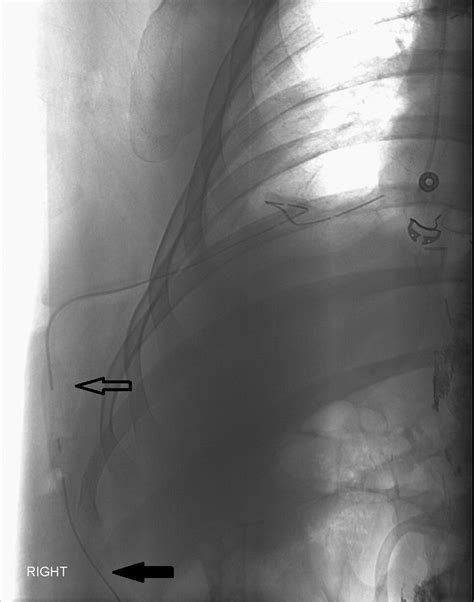 Interventional Radiologic Placement of Denver Pleuroperitoneal Shunt ...