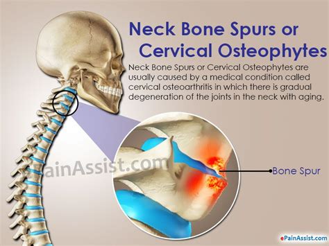 Pin on Bone Spurs In The Neck...