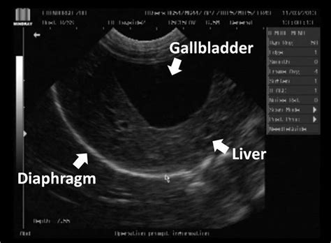 Ultrasound Of Organs | Hot Sex Picture