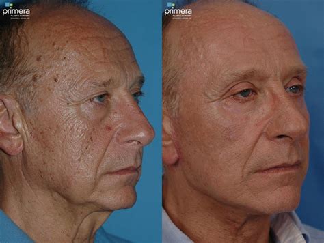 Laser Skin Resurfacing (DOT CO2) Before and After Pictures Case 24 | Orlando, Florida | Primera ...