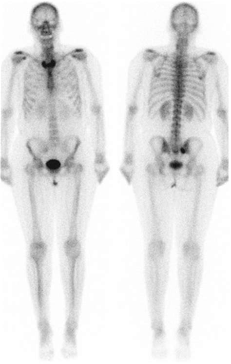 Spondyloarthropathy | Radiology Key